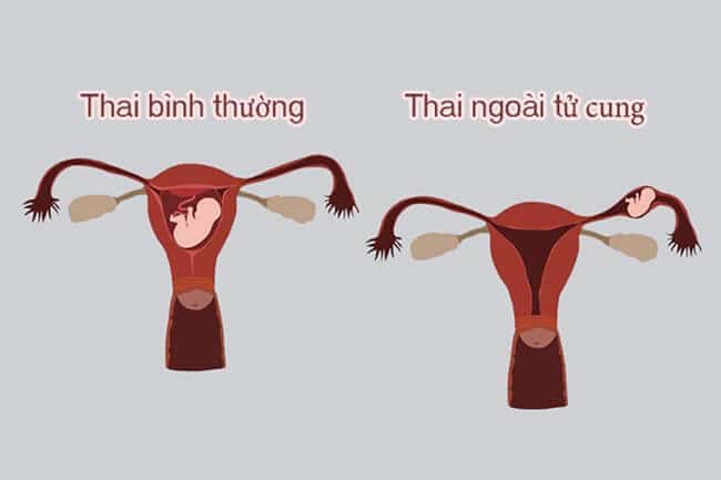 Thai ngoài tử cung cần được phát hiện và xử lý sớm