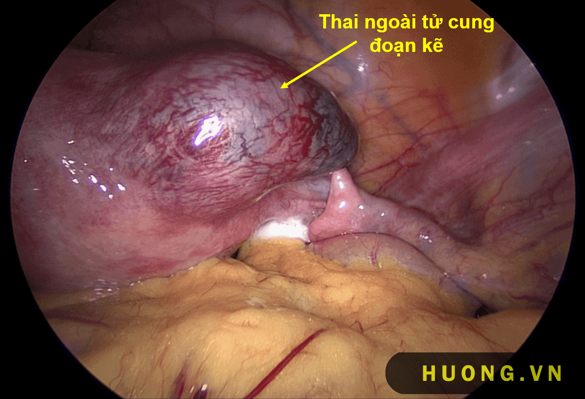 Thai ngoài tử cung