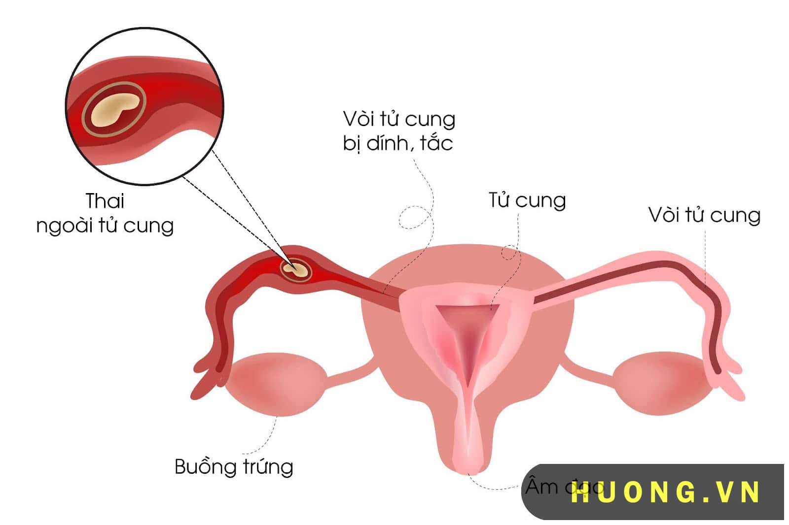 Nhiễm trùng đường tiết niệu 