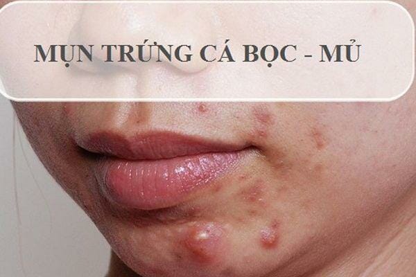 Mụn trứng cá bọc: Nguyên nhân và cách phòng bệnh hiệu quả