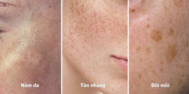 Đồi mồi - nám - tàn nhang: Phân biệt như thế nào đây?
