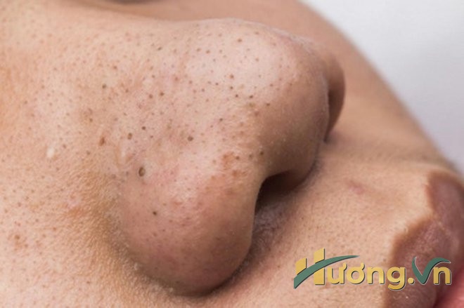 Nếu như không được điều trị kịp thời thì khả năng mụn đầu đen bị viêm nhiễm và sẹo nặng là rất lớn.