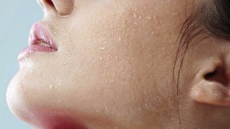 Gợi ý 3 loại treatment cho da khô an toàn và lành tính