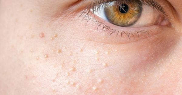 Cách trị mụn gạo: Top 8 cách được ưa chuộng nhất hiện nay
