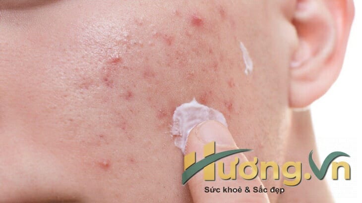 Nhiều người không boaroveej da làm da bị tổn thương nghiêm trọng