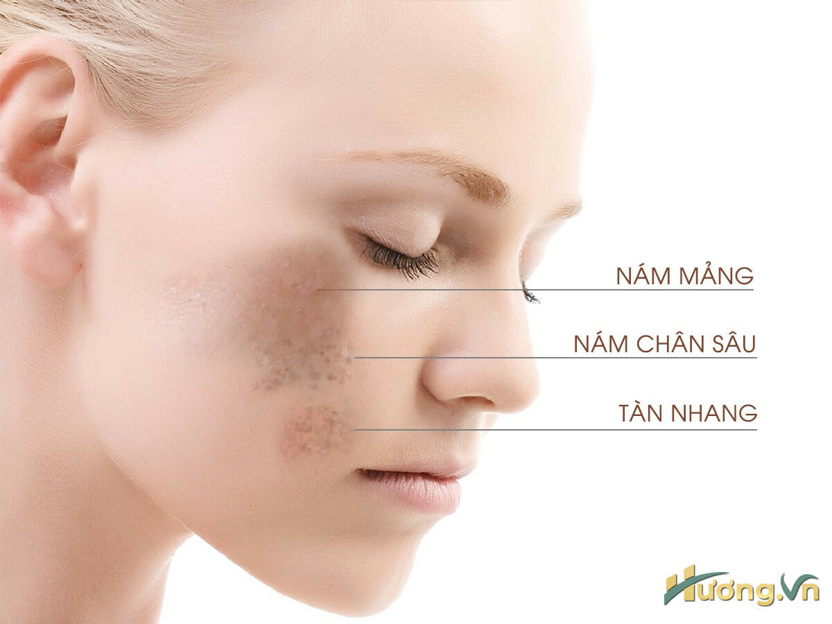Nhiều người làm tượng nám da với lão hóa da là một