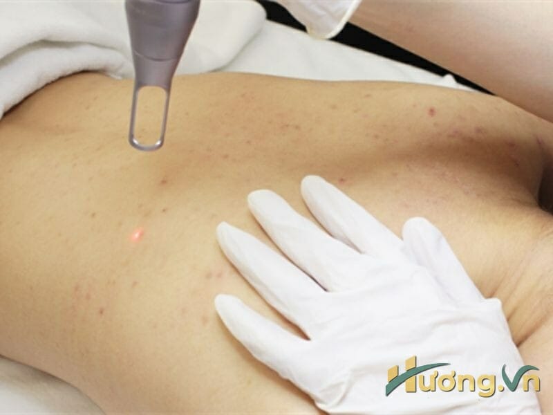 Có 3 liệu trình điều trị mụn lưng chủ chốt tại Spa