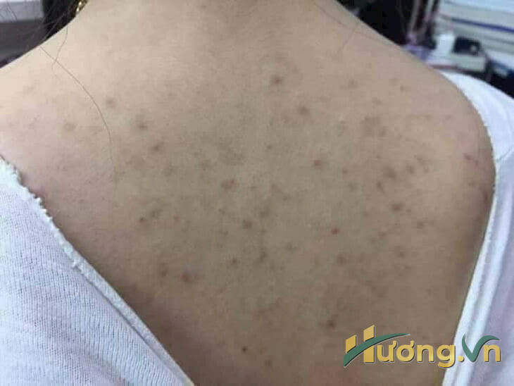 quy trình trị mụn lưng đạt chuẩn y khoa
