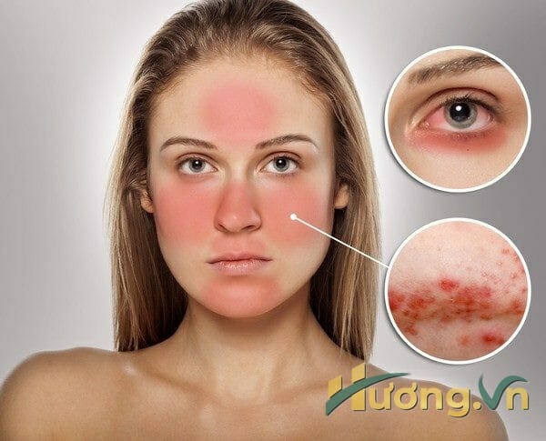 Dù dưỡng chất cần thiết chăm sóc da mụn rất hiệu quả nhưng cũng cần chú ý một số điều cơ bản