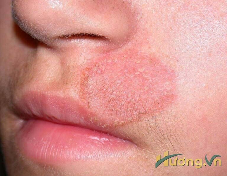 Nấm da mặt tồn tại ở khu vực thượng bì của da