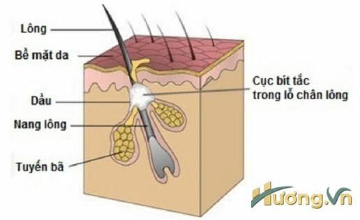 Nguyên nhân hình thành mụn thịt