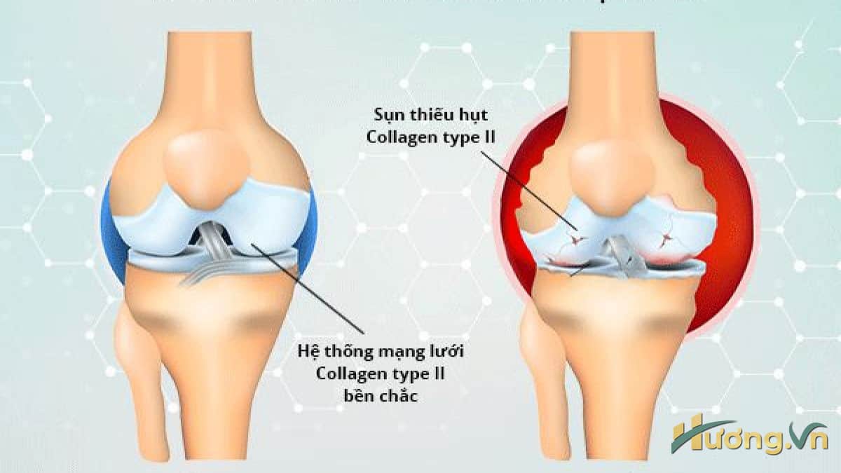 collagen hạn chế tình trạng đau nhức xương khớp
