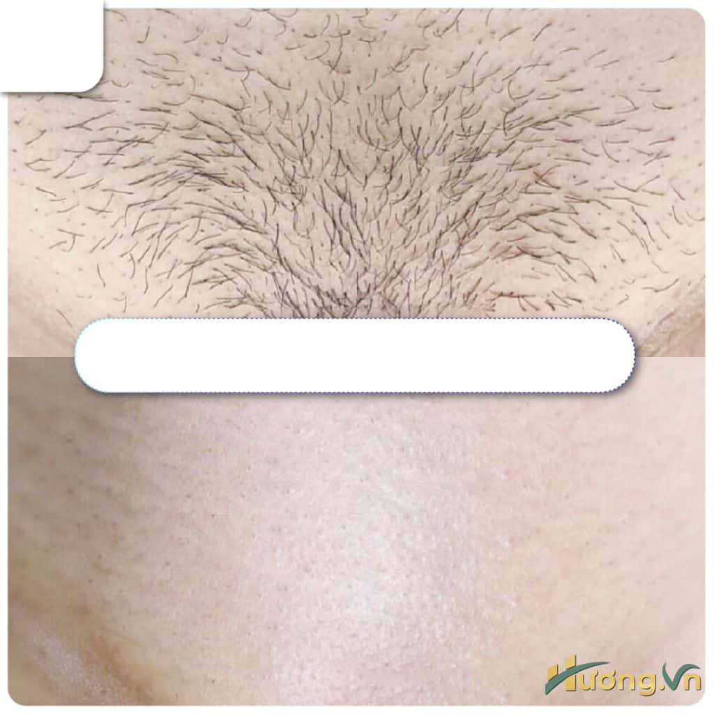 lưu ý trước khi wax lông vùng kín