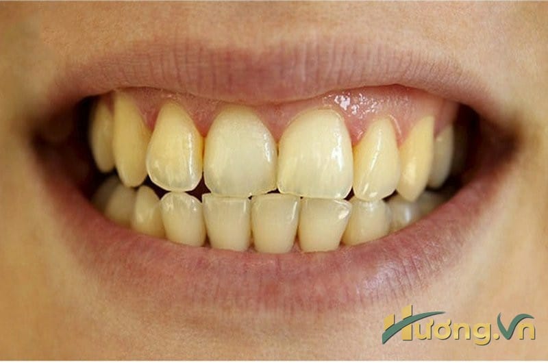 Nguyên nhân gây nên tình trạng ố vàng trên răng