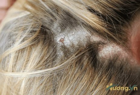 Nấm da đầu gây ra tình trạng ngứa