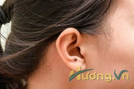 Tại sao không nên tẩy nốt ruồi tại nhà?