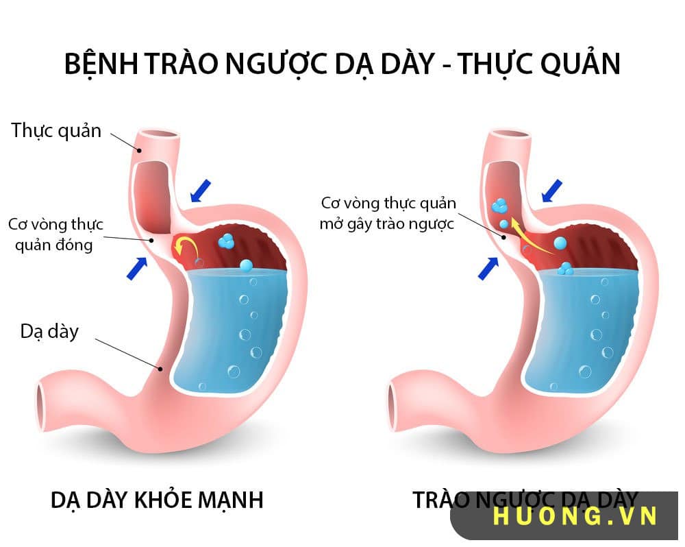  trào ngược dạ dày