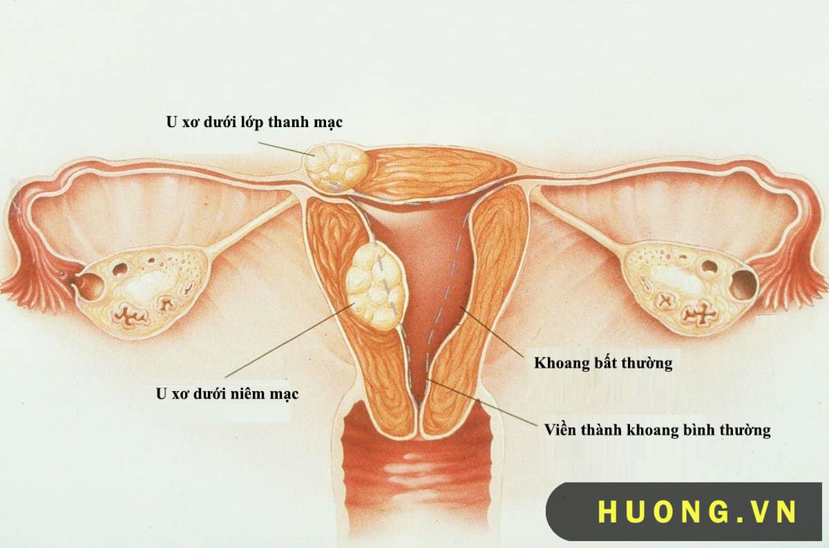 bệnh u xơ tử cung 