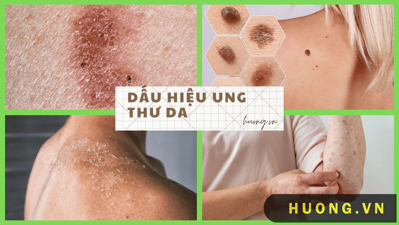 dấu hiệu ung thư da giai đoạn đầu