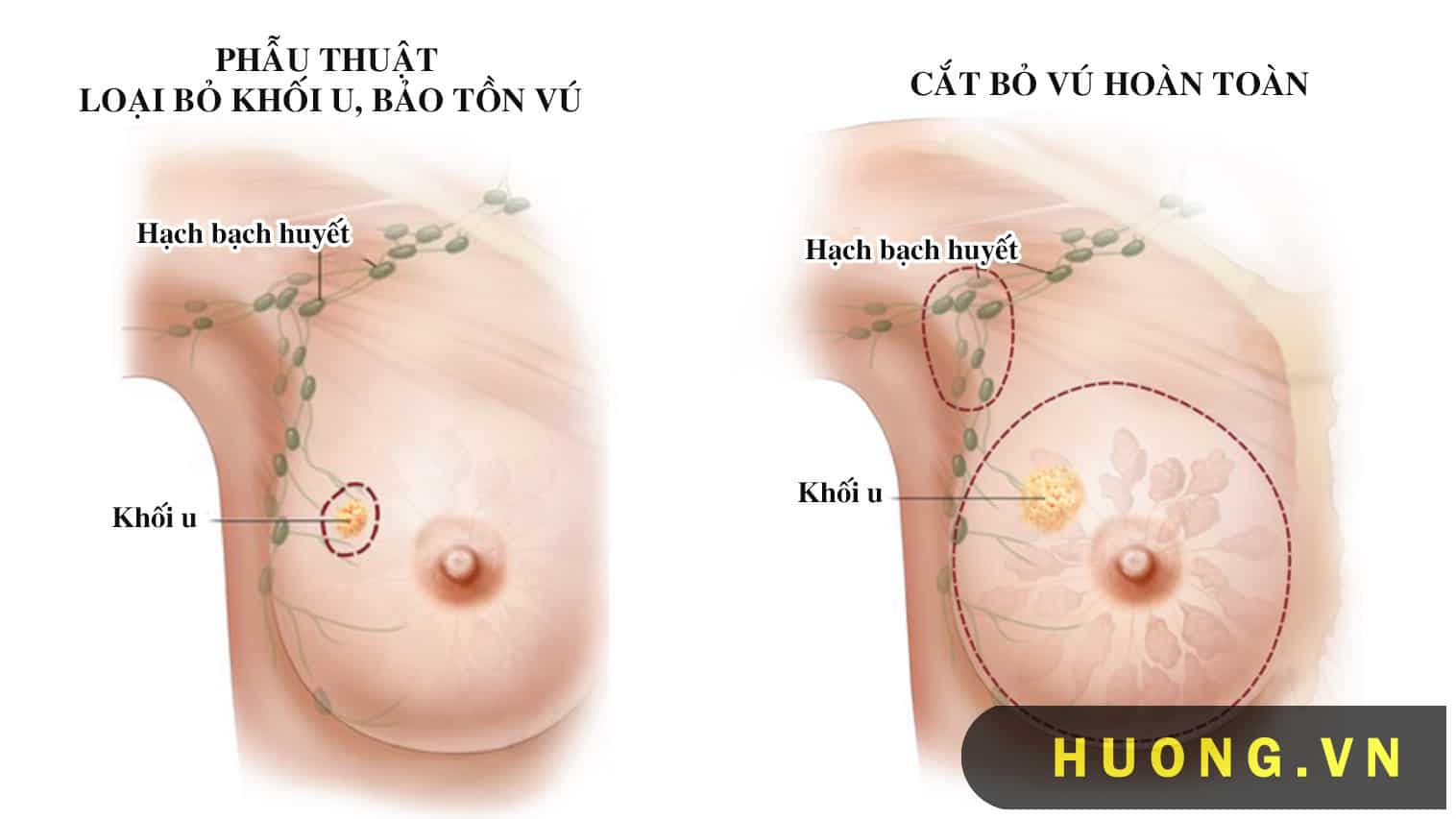 Ung thư vú có nguy hiểm không