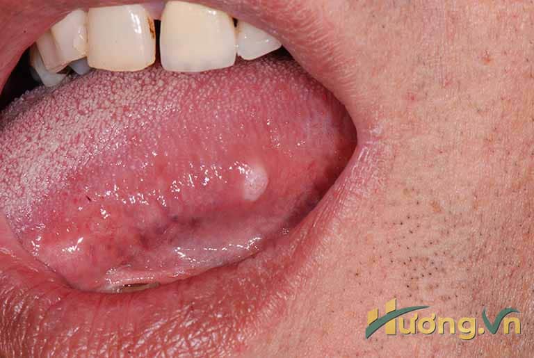 Nguyên nhân nhiệt miệng ở lưỡi