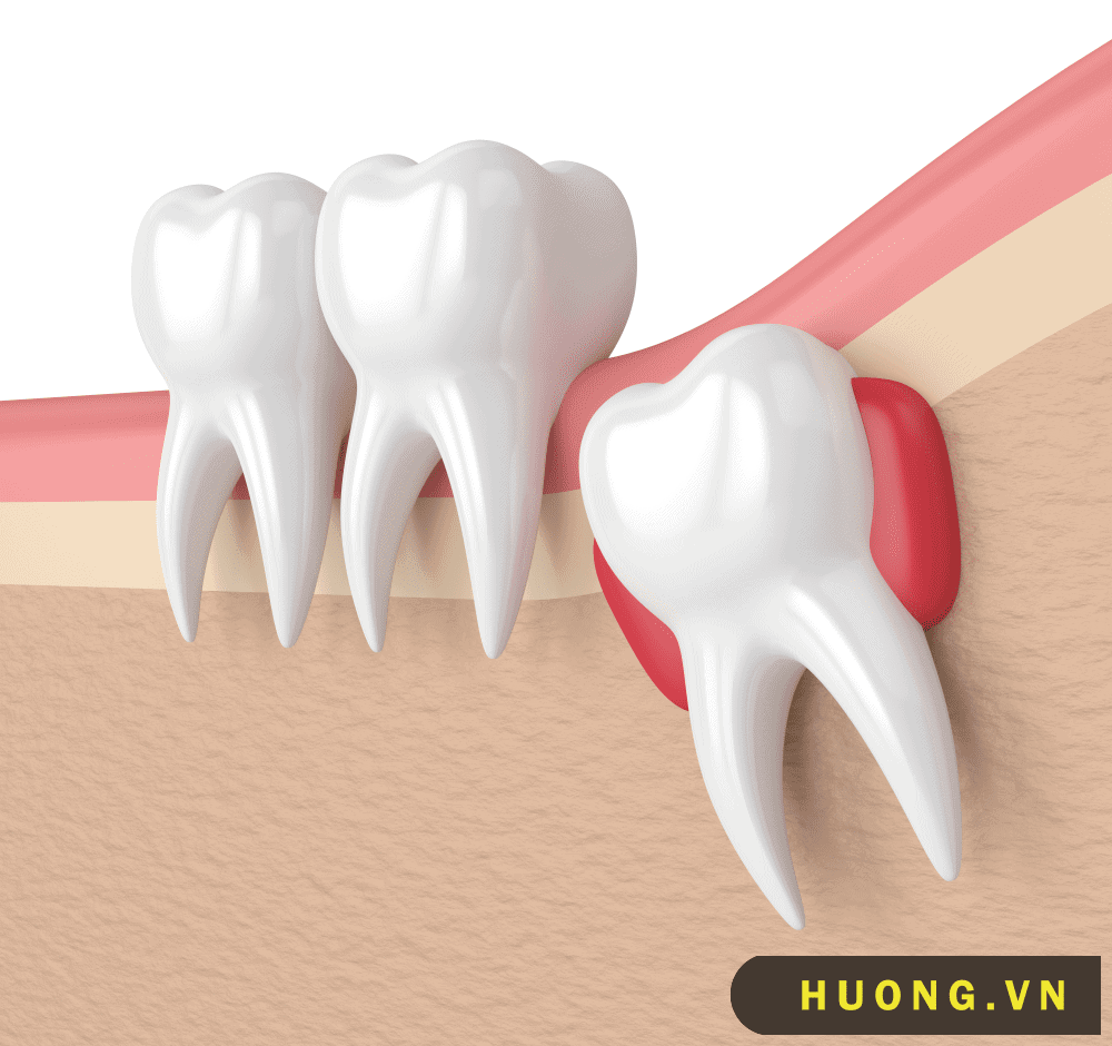 Răng khôn mọc lệch