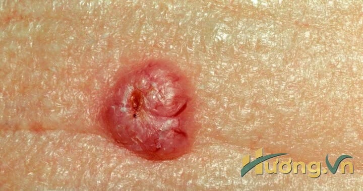 mụn cứng và màu vàng