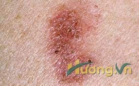 Cách phòng ngừa nguy cơ ung thư da