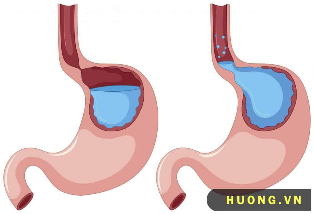 trào ngược dạ dày