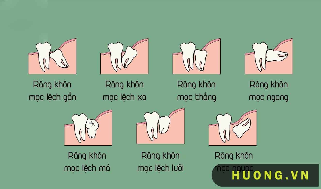 Hướng mọc của răng khôn