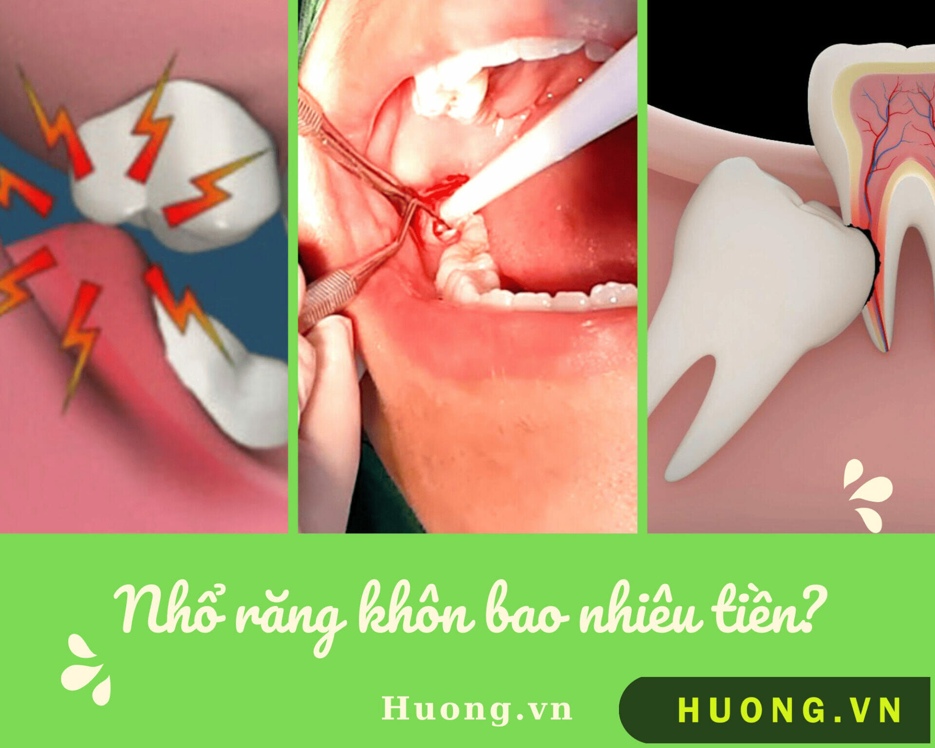 nho rang khon bao nhieu tien9 1