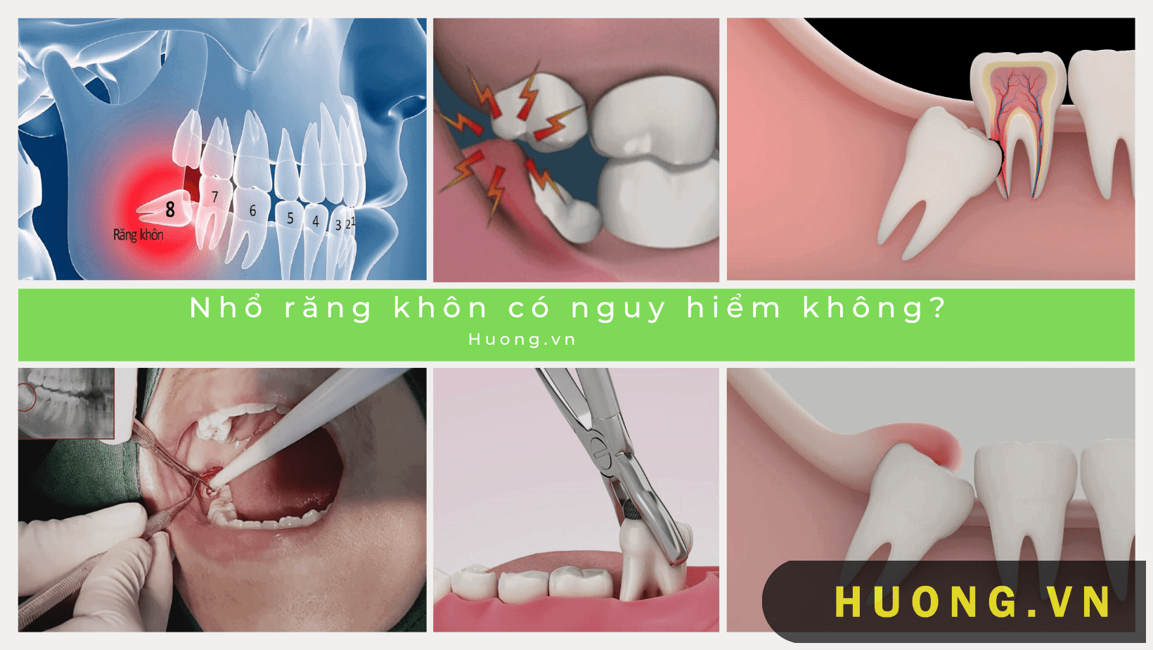 nhổ răng khôn có nguy hiểm không