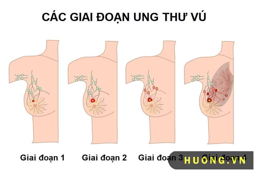 các giai đoạn ung thư vú