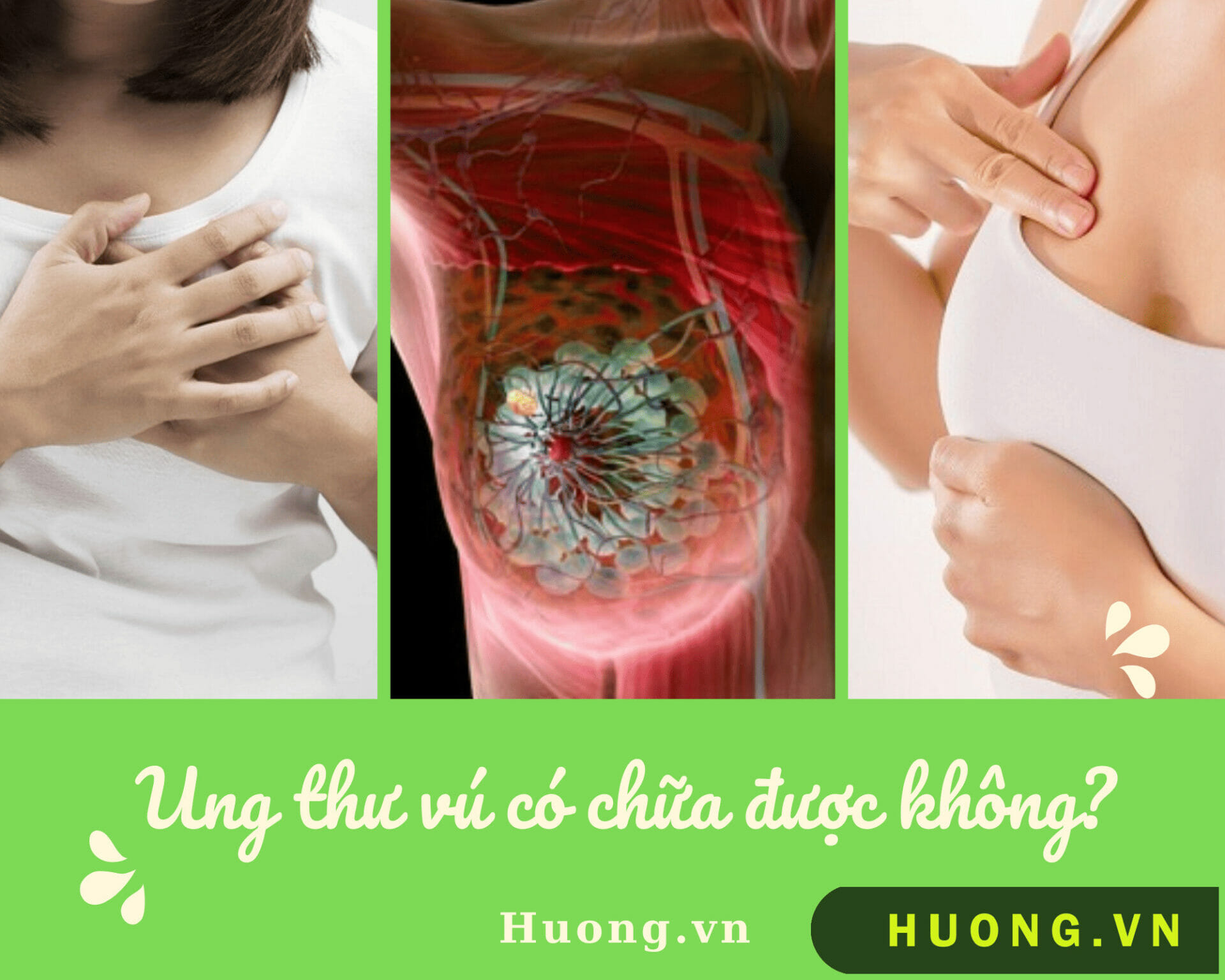 Ung thư vú có chữa được không