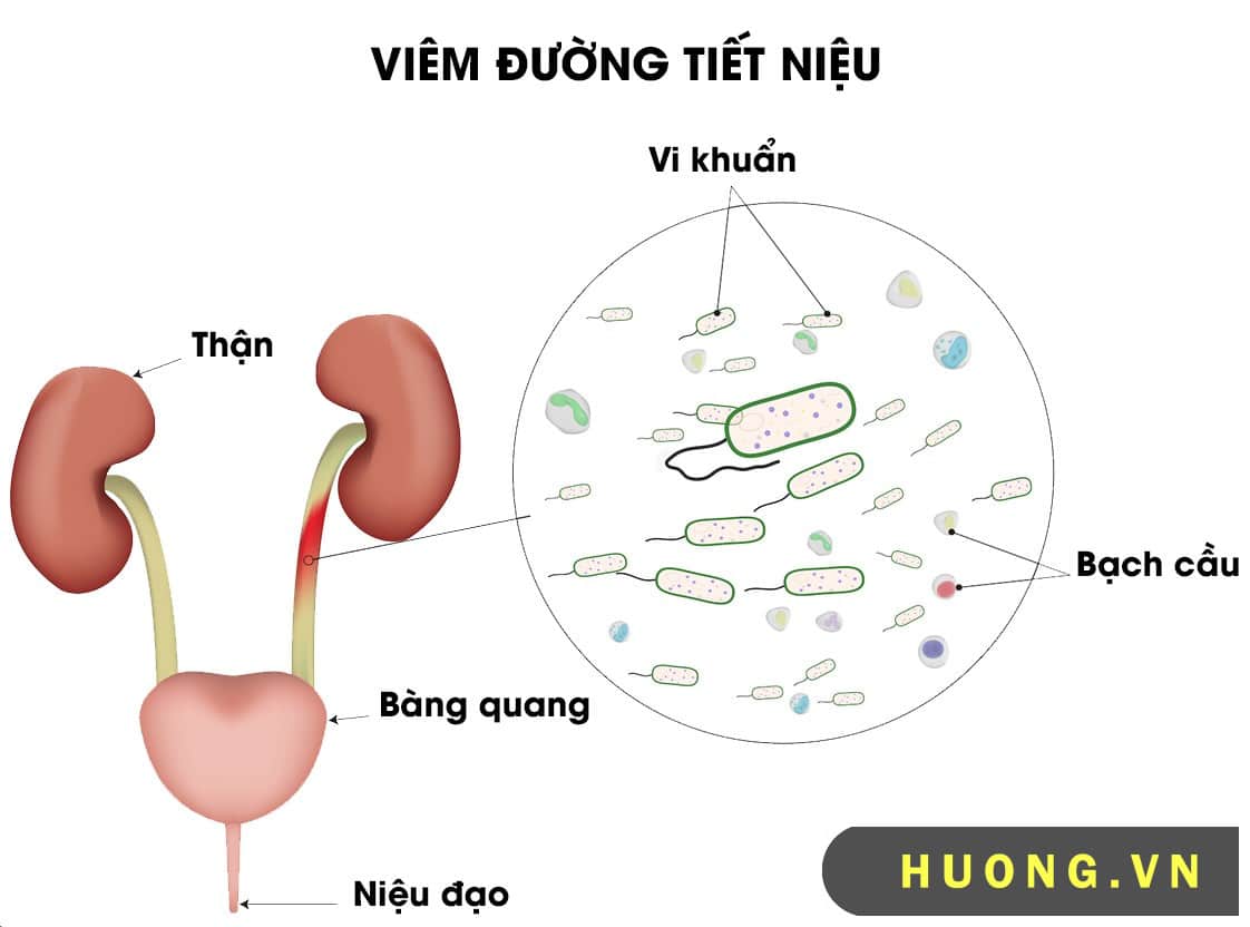 Hình ảnh viêm đường tiết niệu